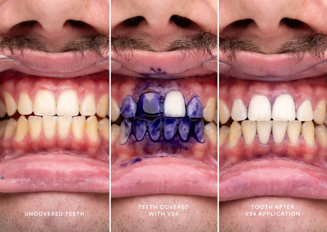 ...Sérum de Blanchiment Dentaire MEANSMILE™